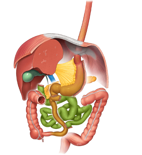 duodenal-switch-pop-up